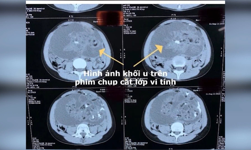 Hải Ph&ograve;ng: Phẫu thuật th&agrave;nh c&ocirc;ng khối u buồng trứng nặng hơn 6kg ở bệnh nhi 9 tuổi