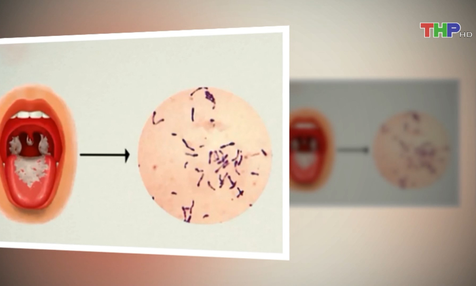 Giải ph&aacute;p ph&ograve;ng ngừa bệnh bạch hầu