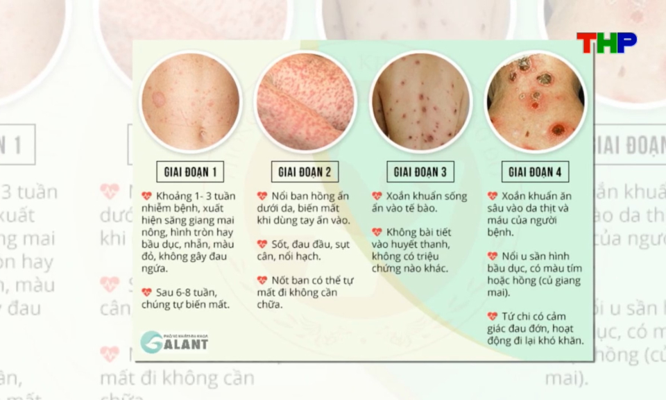 Y học 360: Bệnh giang mai nguy&ecirc;n nh&acirc;n, dấu hiệu v&agrave; c&aacute;ch ph&ograve;ng ngừa