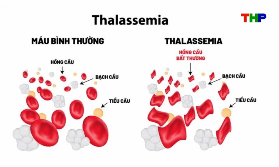 Tăng cường tuy&ecirc;n truyền, n&acirc;ng cao nhận thức về bệnh tan m&aacute;u bẩm sinh